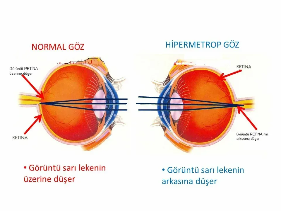 Hipermetrop Komplikasyonları