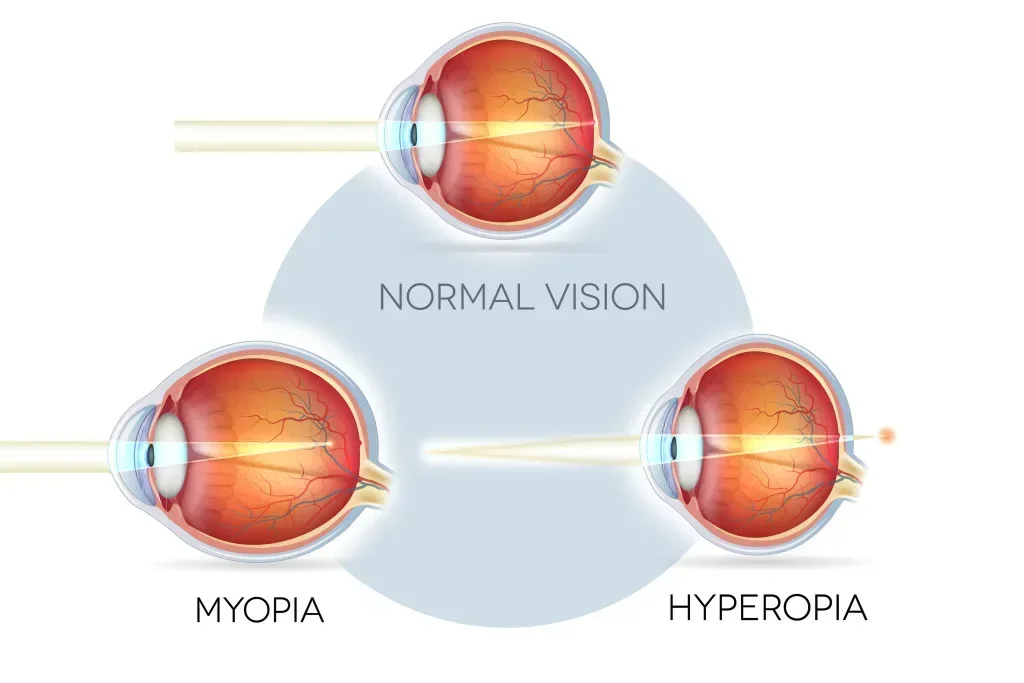 Hipermetropi