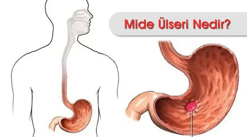 Aktif Kronik Gastrit Kötü mü?