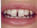 Aralıklı Dişler (Diastema)