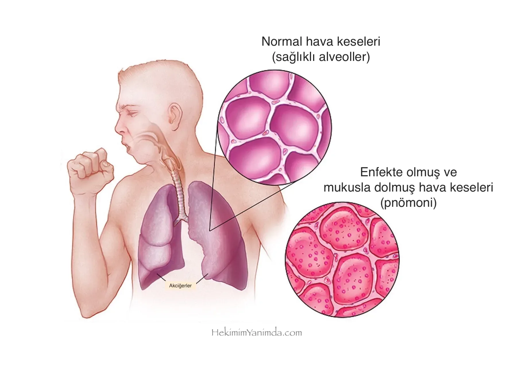 Zatürre Nedir? Zatürre belirtileri nelerdir?