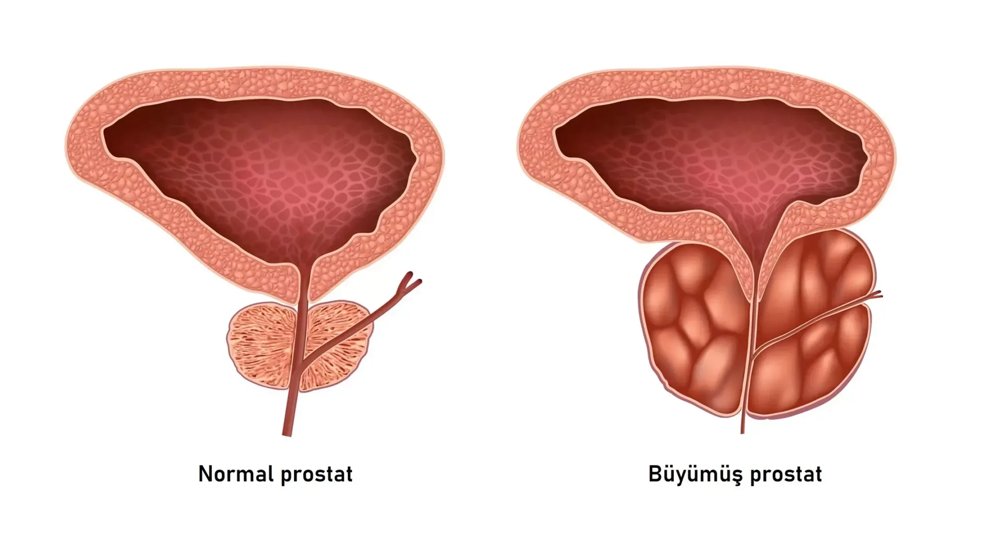 Kronik prostatit nasıl tedavi edilir?