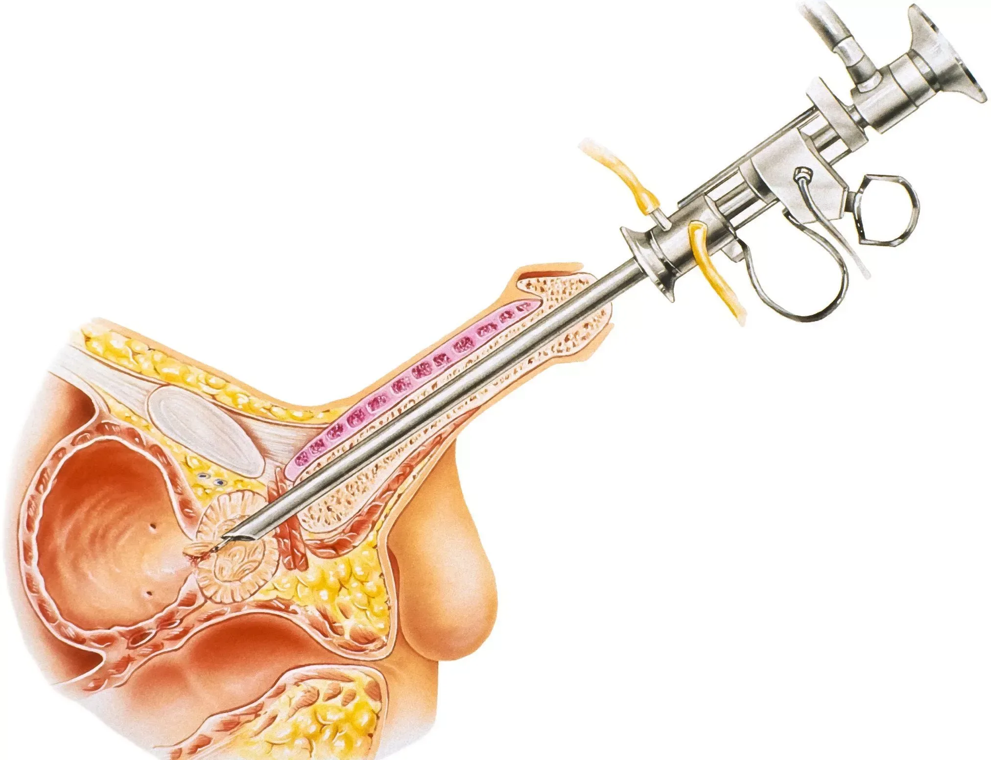 Benign Prostat Hiperplazisi (BPH) nedir?