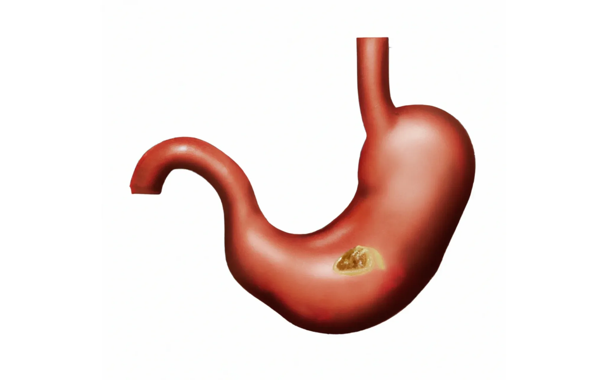 Aktif Kronik Gastrit